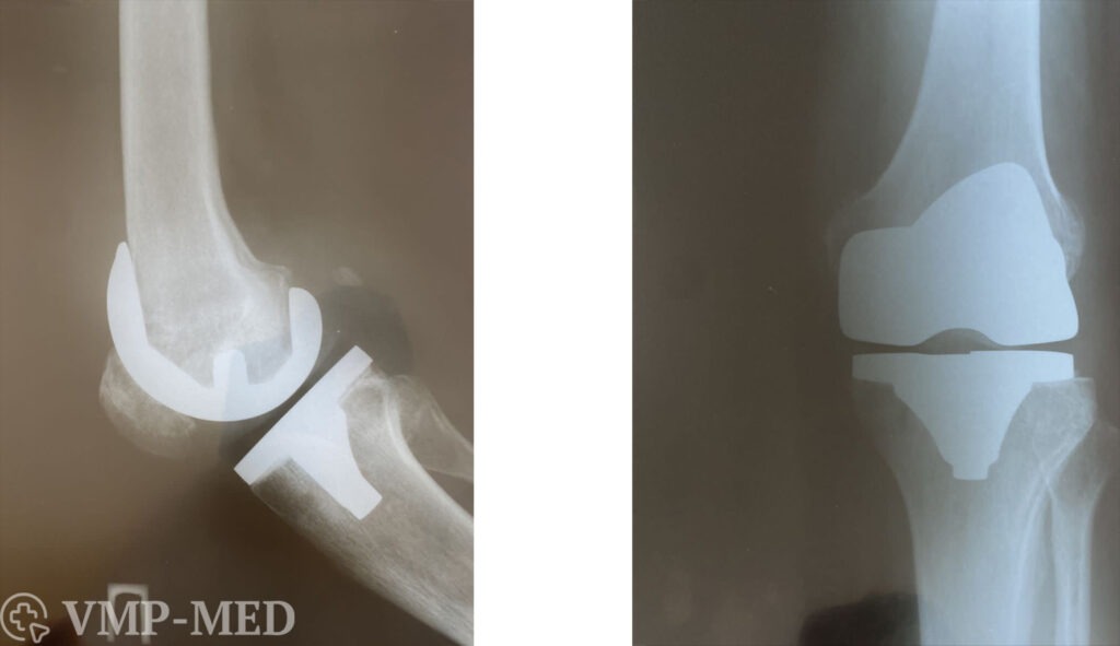 Рентген после эндопротезирование коленного сустава с одновременной реконструкцией биологической оси конечности