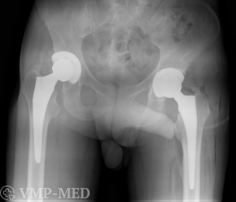 Рентген после эндопротезирования двух тазобедренных суставов