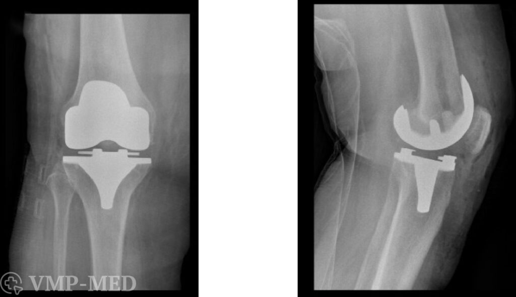Рентген после эндопротезирования коленного сустава