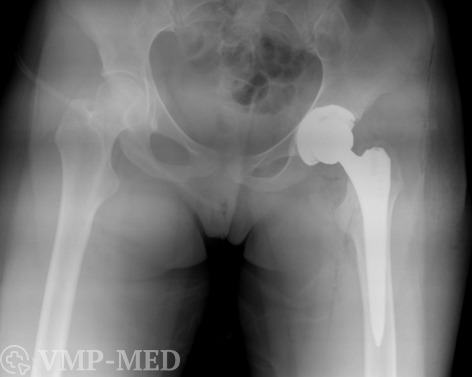 Рентген после тотального эндопротезирования тазобедренного сустава