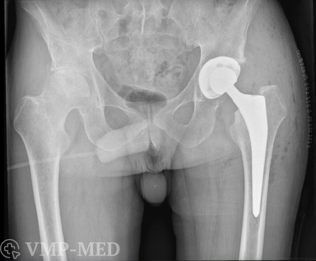 Снимок рентгена после эндопротезирования ТБС