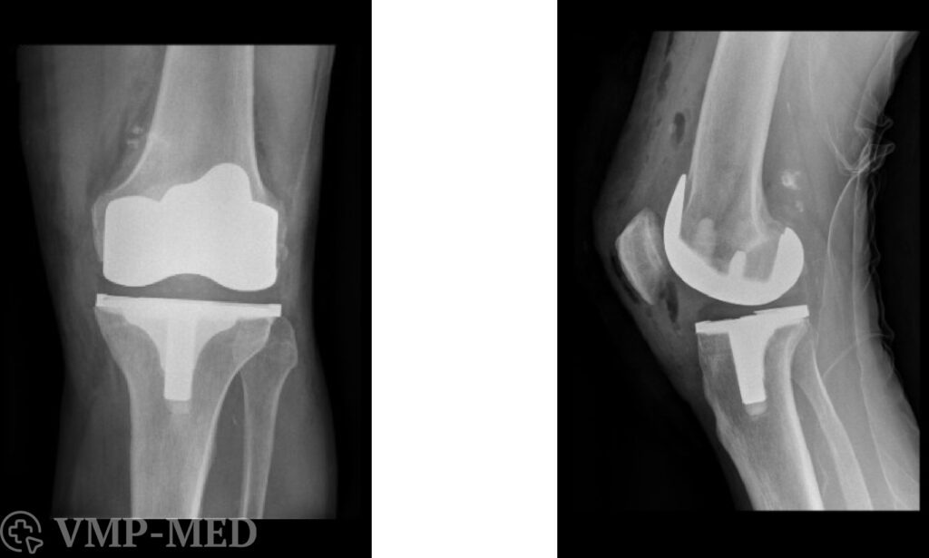 Снимок рентгена после замены коленного сустава